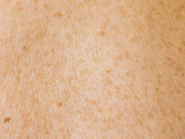 Infektioner är vanliga hos personer med eksem