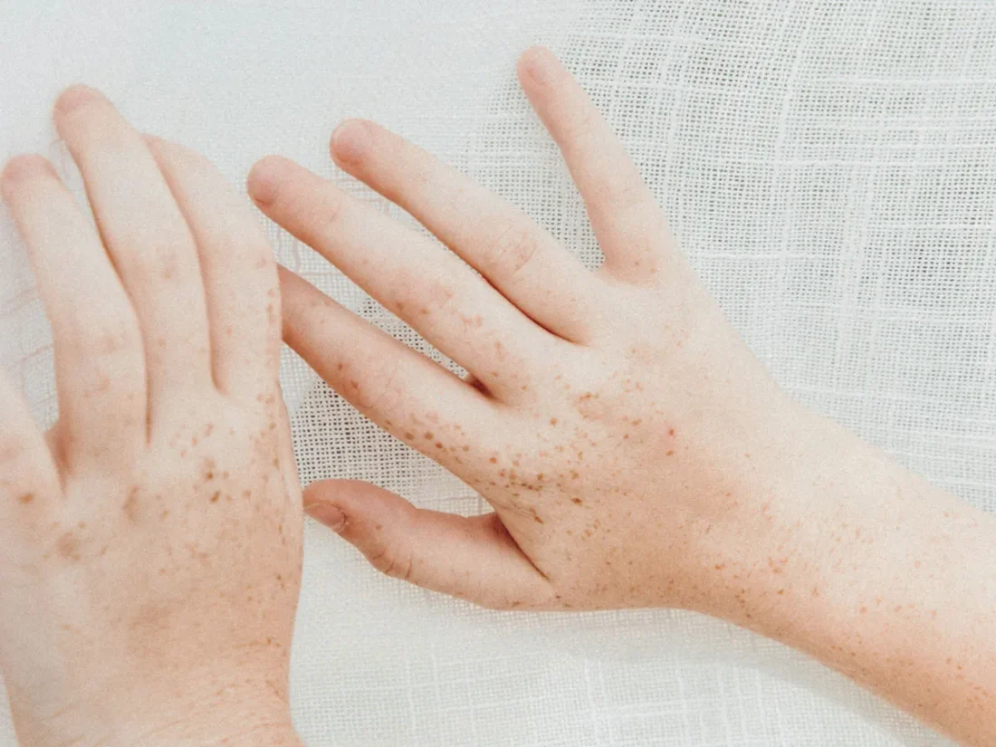 Närbild mindre händer med fräknar mot ett vitt skirt tyg